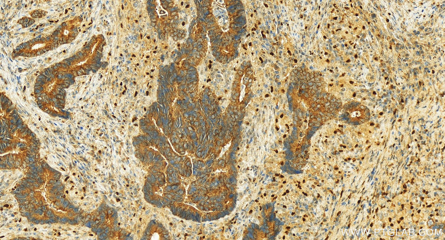 IHC staining of human colon cancer using 30036-1-AP (same clone as 30036-1-PBS)