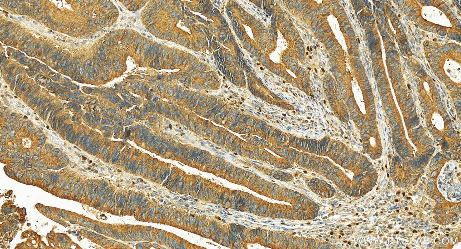 IHC staining of human colon cancer using 30036-1-AP (same clone as 30036-1-PBS)