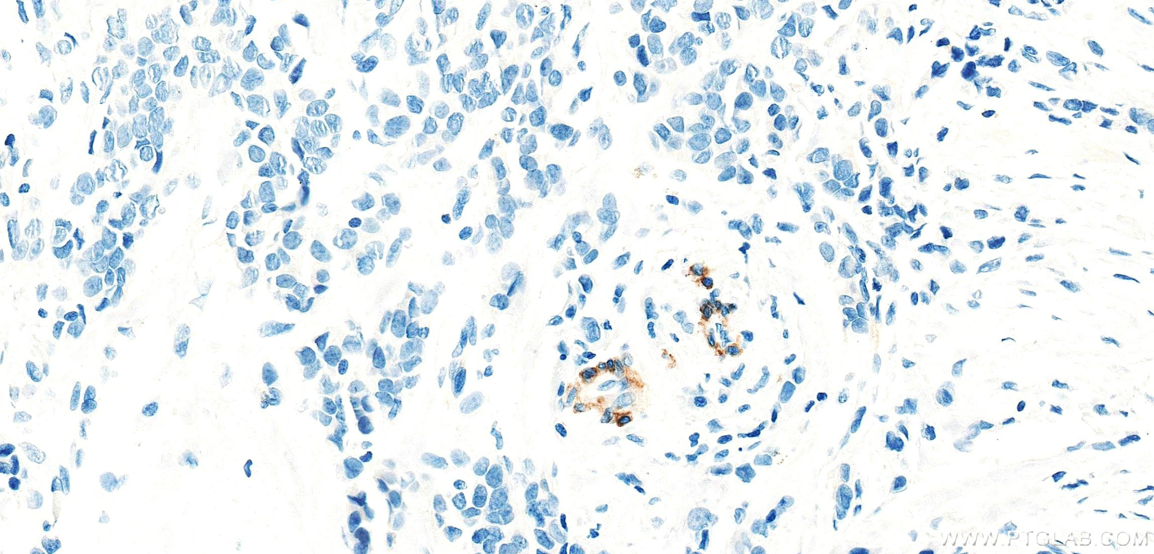 IHC staining of human breast cancer using 86654-3-RR