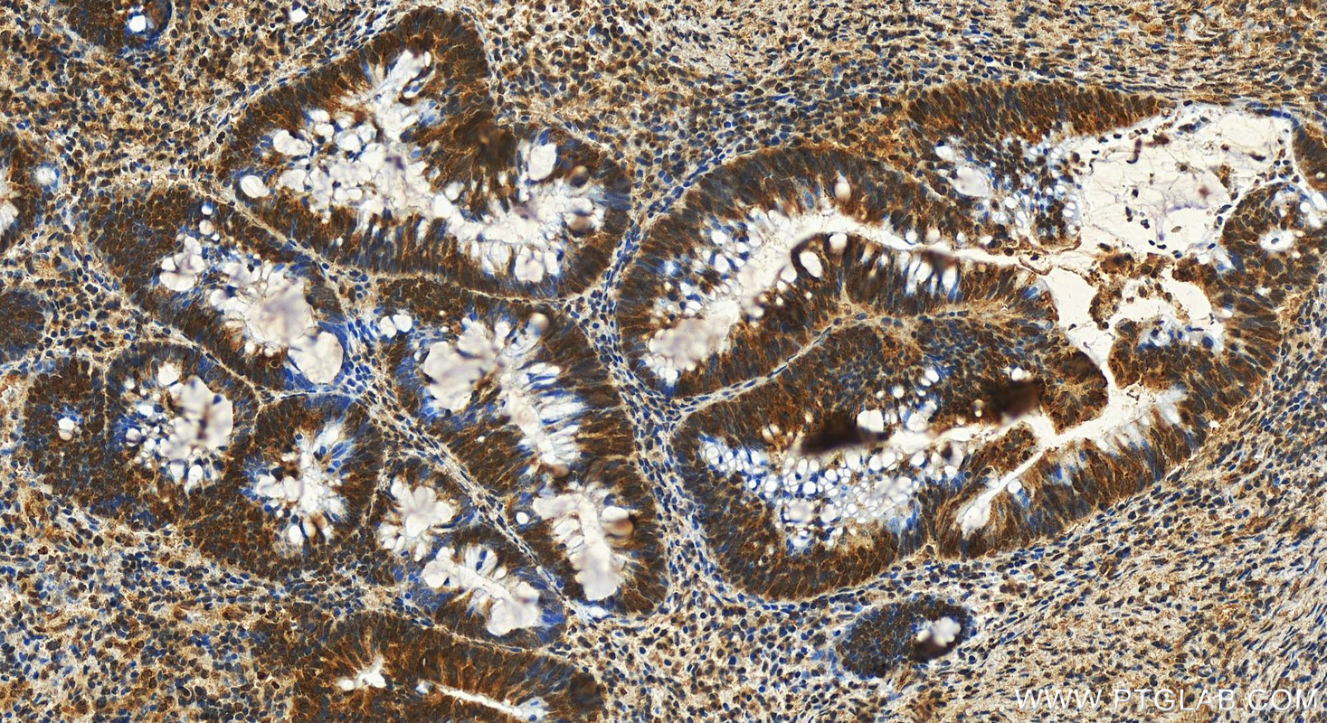 IHC staining of human colon  cancer using 60154-2-Ig