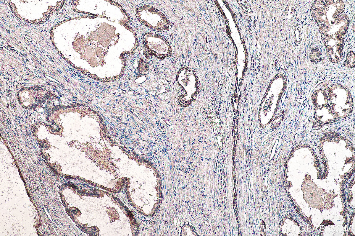 IHC staining of human prostate cancer using 66851-1-Ig