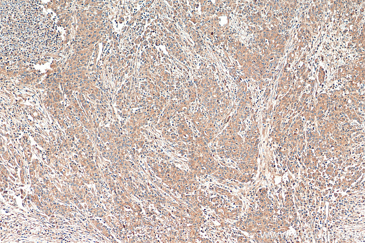 IHC staining of human stomach cancer using 15052-1-AP