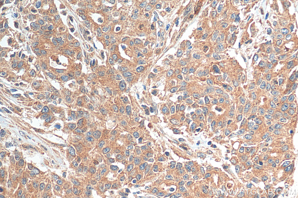 IHC staining of human stomach cancer using 15052-1-AP (same clone as 15052-1-PBS)