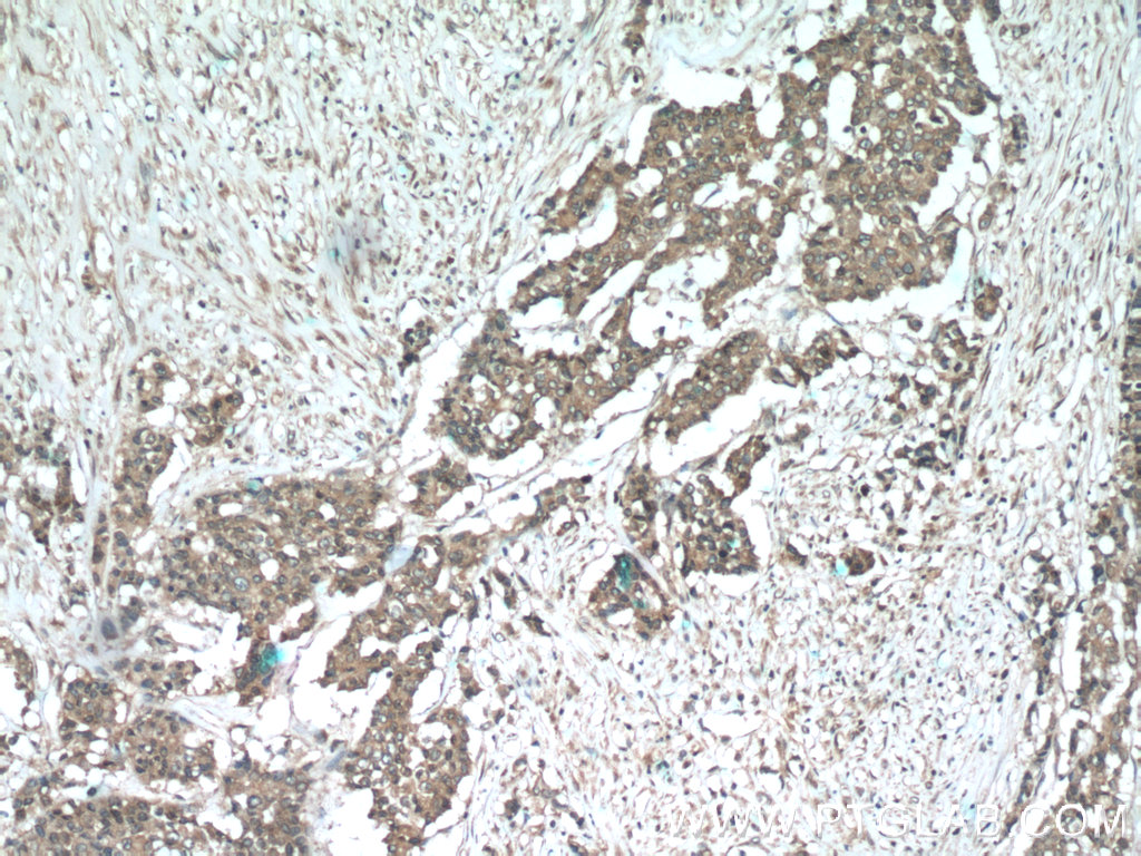 IHC staining of human colon cancer using 55175-1-AP