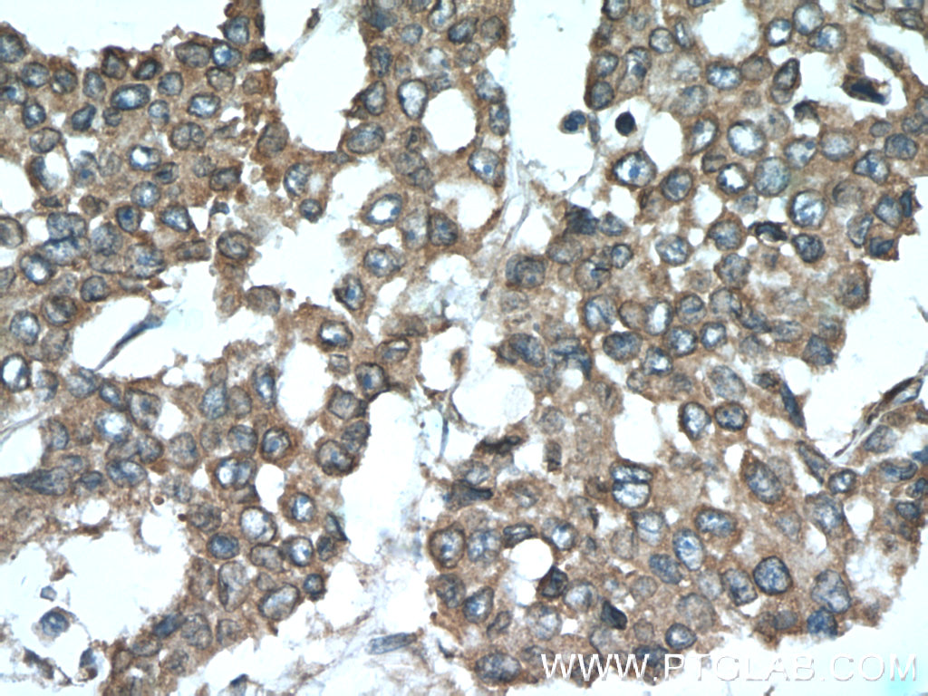 IHC staining of human colon cancer using 55175-1-AP
