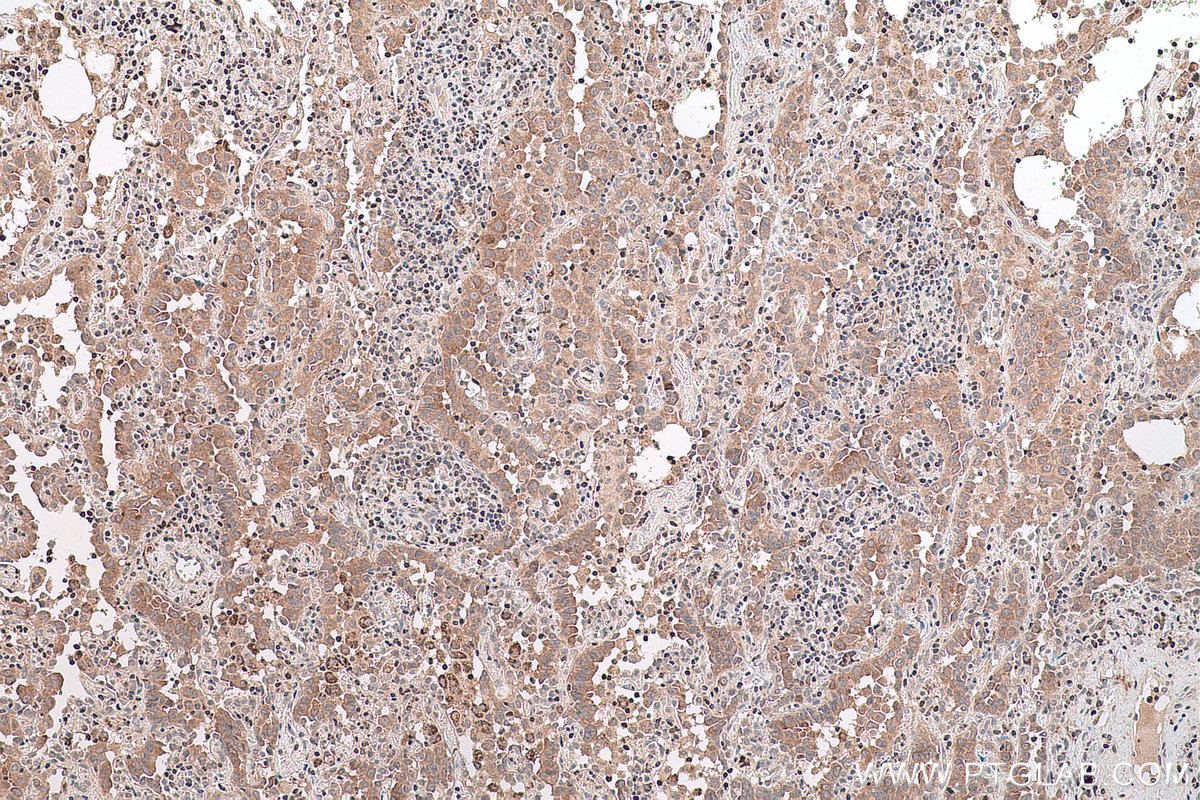IHC staining of human lung cancer using 21290-1-AP IHC staining of human lung cancer using 21290-1-AP