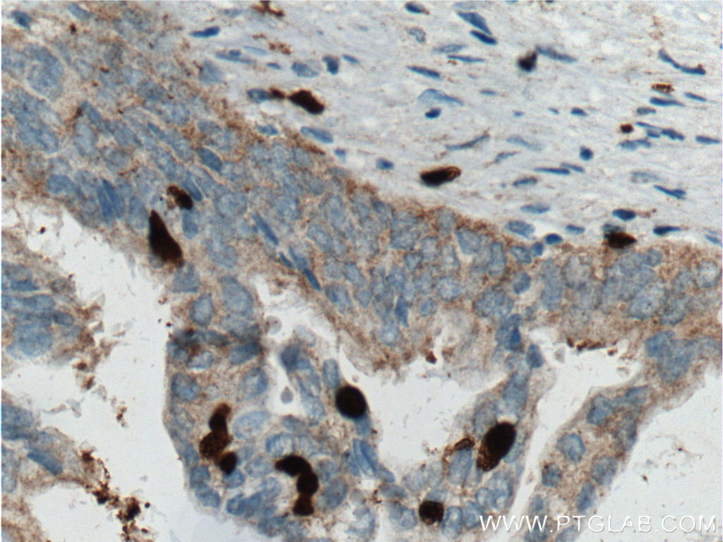 IHC staining of human pancreas cancer using 66330-1-Ig