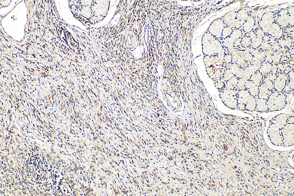 IHC staining of human stomach cancer using 13099-1-AP