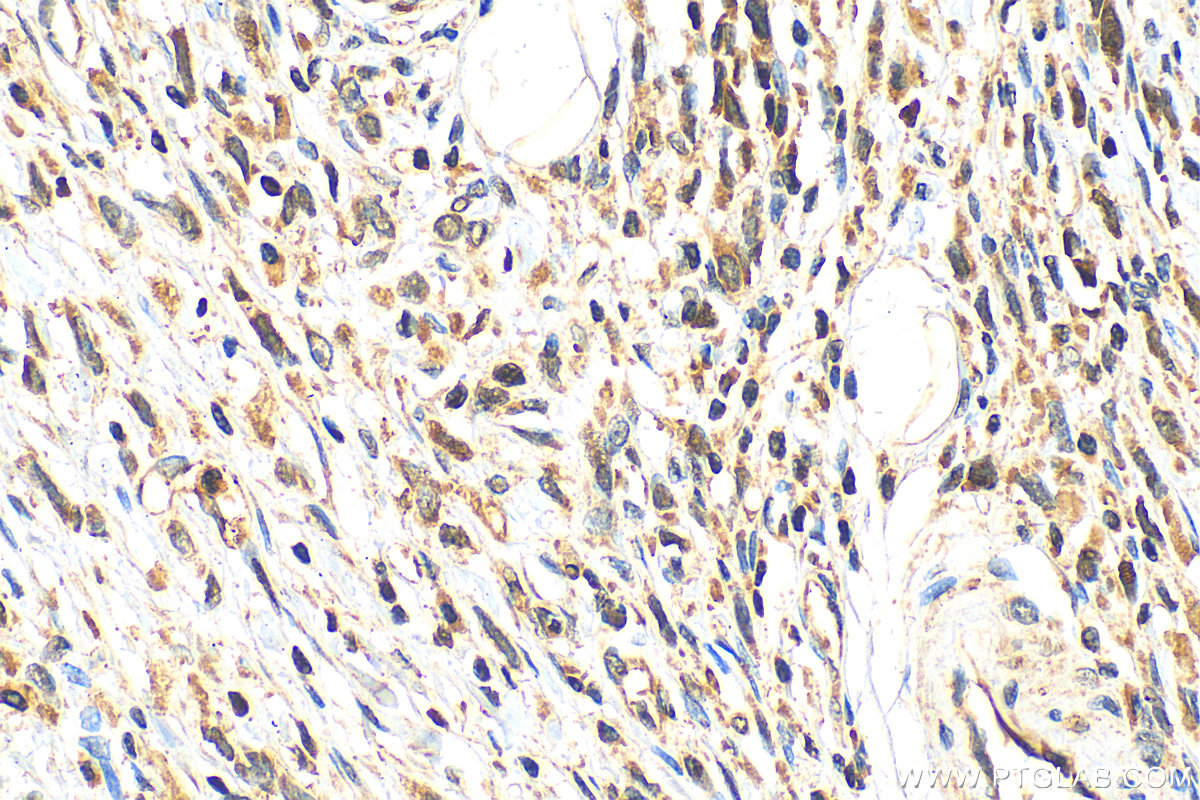 IHC staining of human stomach cancer using 13099-1-AP