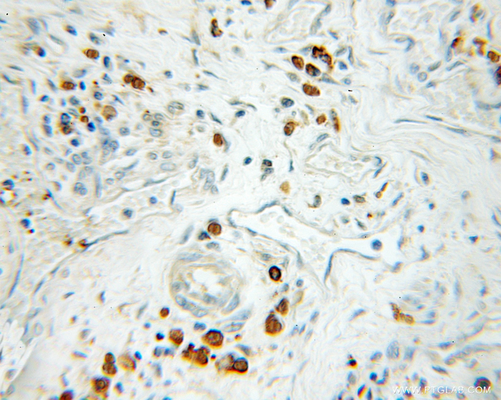 IHC staining of human colon cancer using 11297-1-AP
