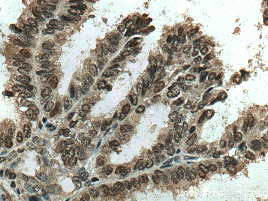 IHC staining of human ovary tumor using 10697-1-AP