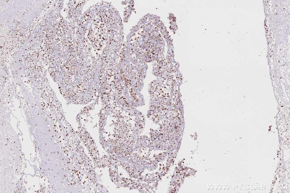 IHC staining of human ovary cancer using 82962-1-RR