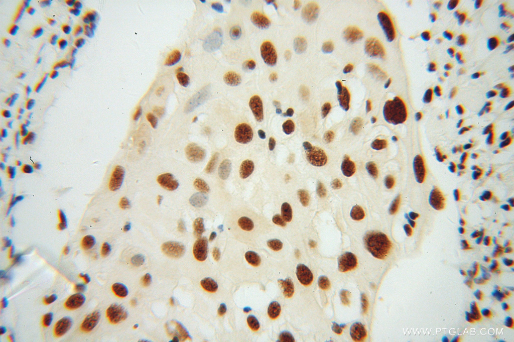 IHC staining of human cervical cancer using 13512-1-AP