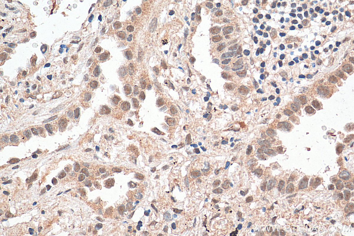 IHC staining of human lung cancer using 10379-1-AP