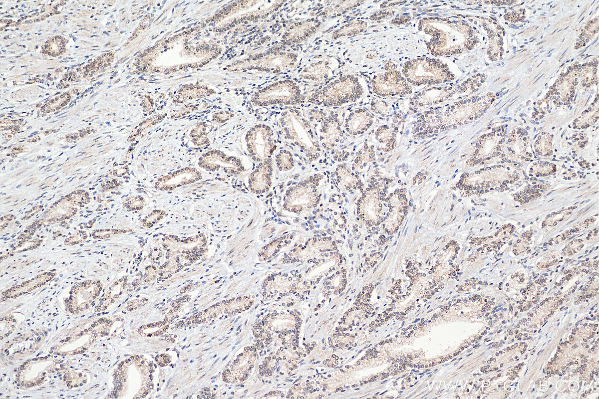 IHC staining of human prostate cancer using 25926-1-AP