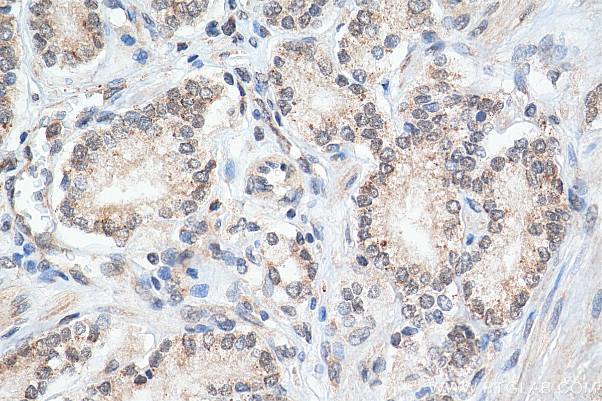 IHC staining of human prostate cancer using 25926-1-AP