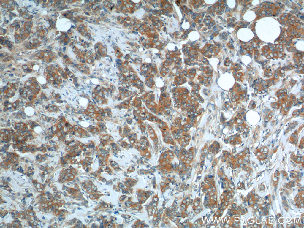 IHC staining of human breast cancer using 10304-1-AP