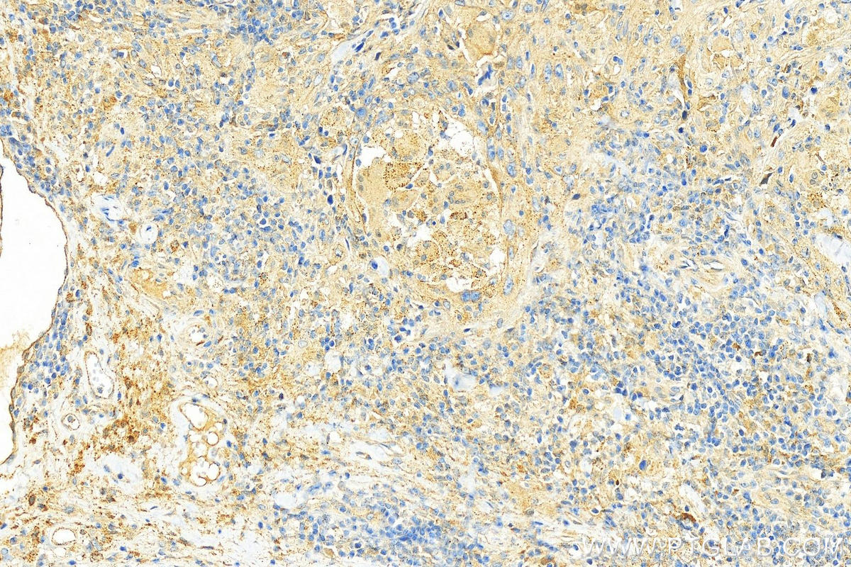IHC staining of human skin cancer using 10772-1-AP