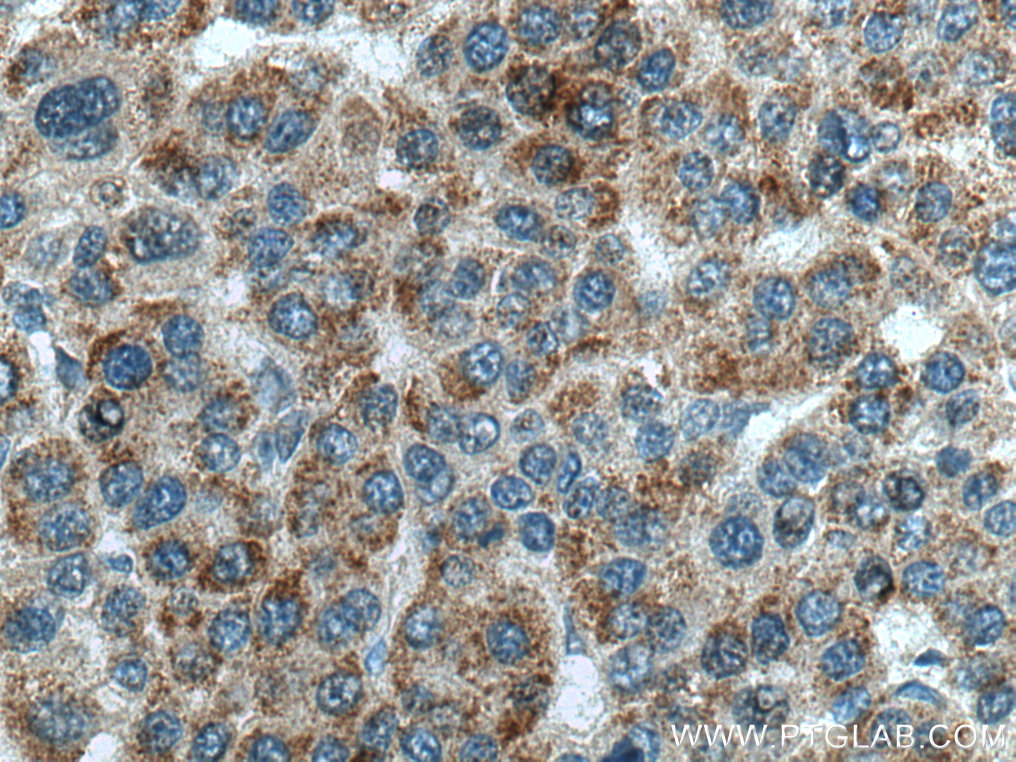 IHC staining of human liver cancer using 67665-1-Ig (same clone as 67665-1-PBS)