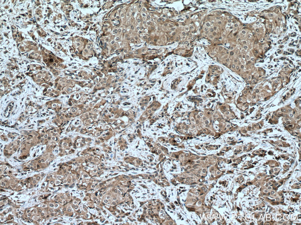 IHC staining of human breast cancer using 66797-1-Ig (same clone as 66797-1-PBS)