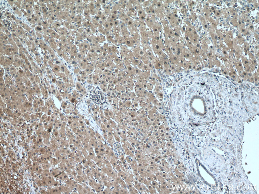 IHC staining of human liver cancer using 10269-1-AP