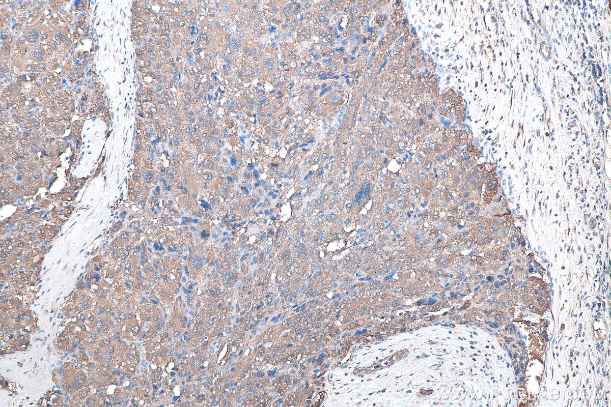 IHC staining of human liver cancer using 67480-1-Ig IHC staining of human liver cancer using 67480-1-Ig