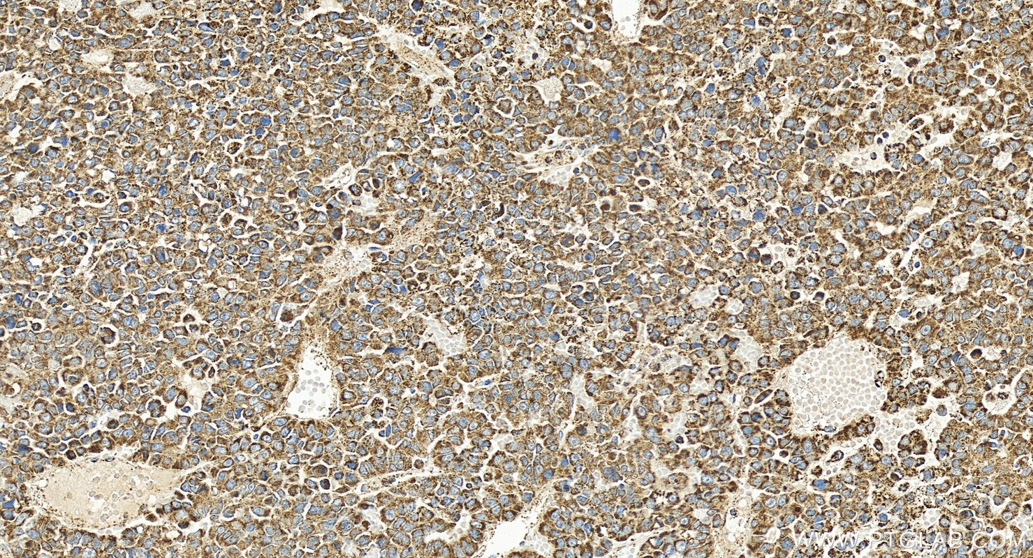 IHC staining of human hepatocellular carcinoma using 24127-1-AP