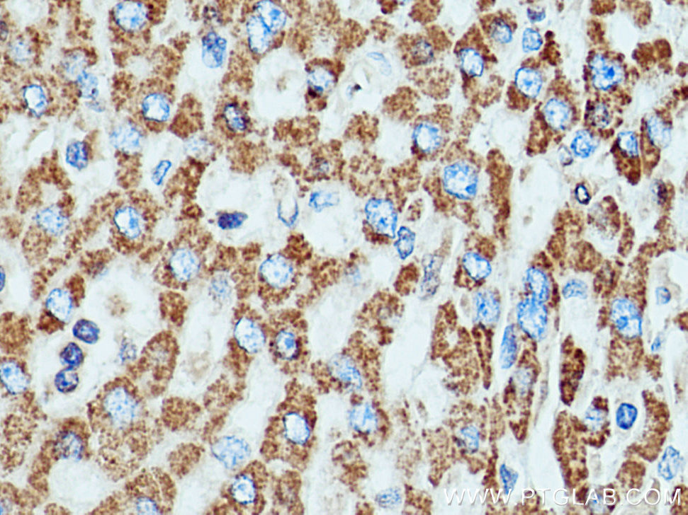 IHC staining of human liver cancer using 24127-1-AP