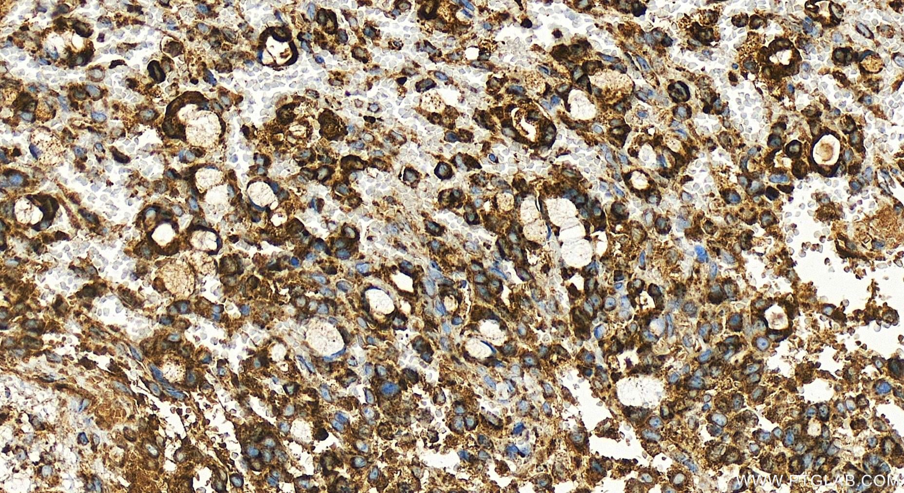 IHC staining of human ovary cancer using 83519-3-RR