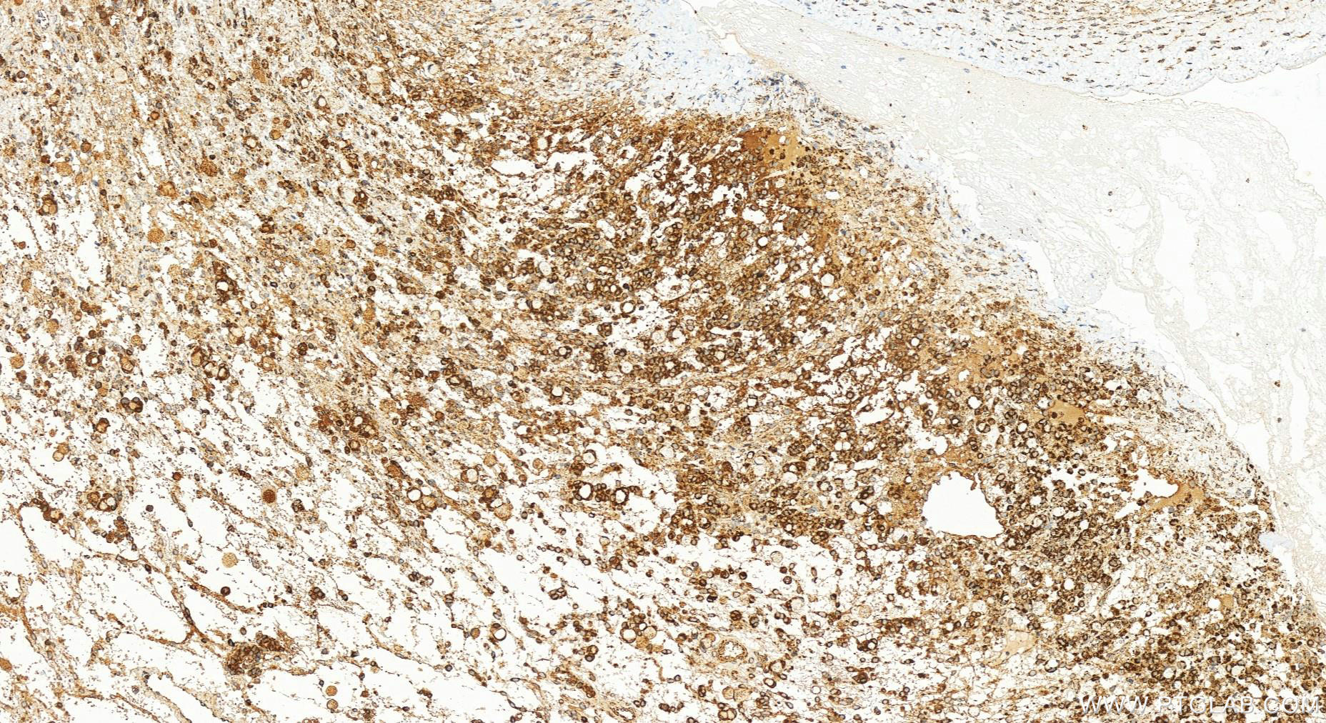 IHC staining of human ovary cancer using 83519-4-RR (same clone as 83519-4-PBS)