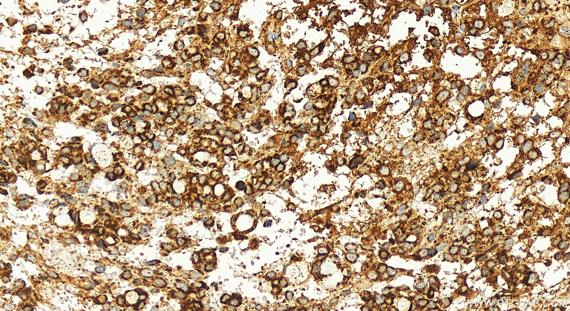 IHC staining of human ovary cancer using 83519-4-RR (same clone as 83519-4-PBS)