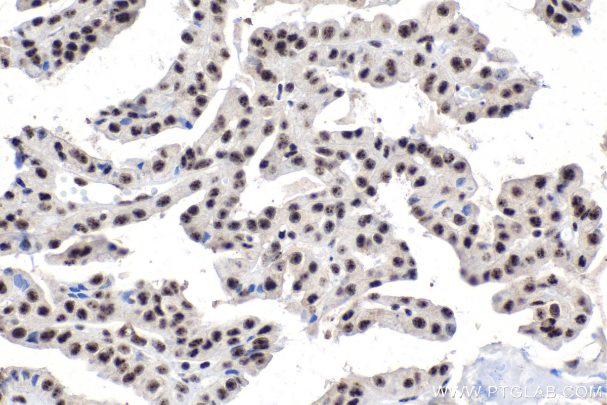 IHC staining of human thyroid cancer using 28046-1-AP