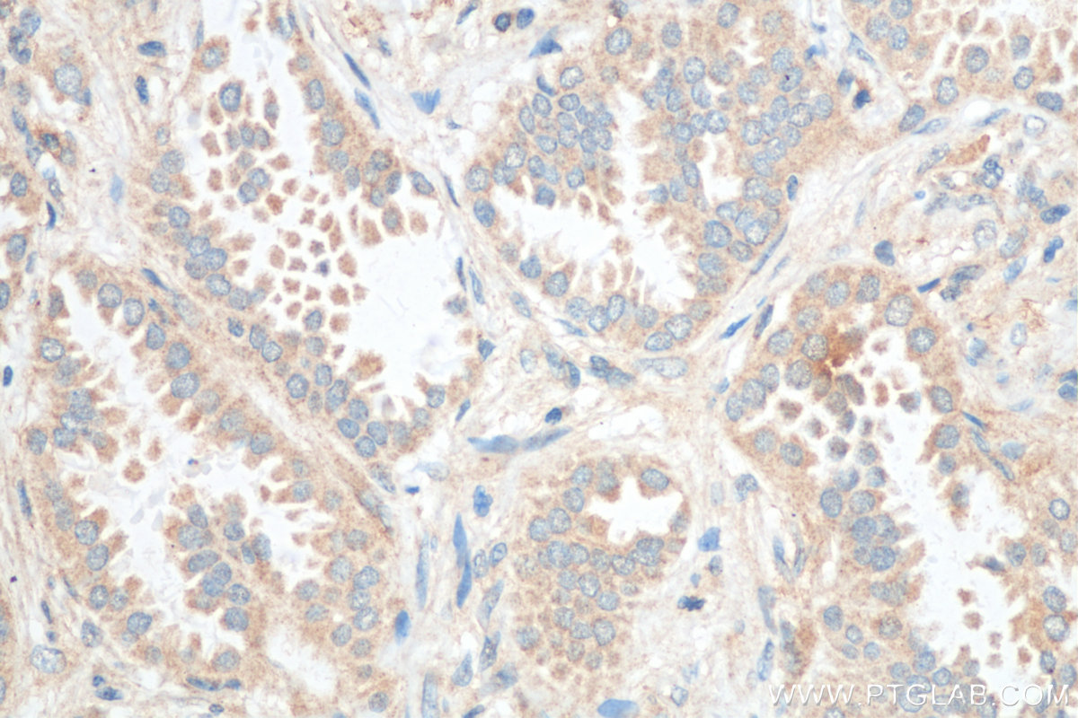 IHC staining of human lung cancer using 55041-1-AP