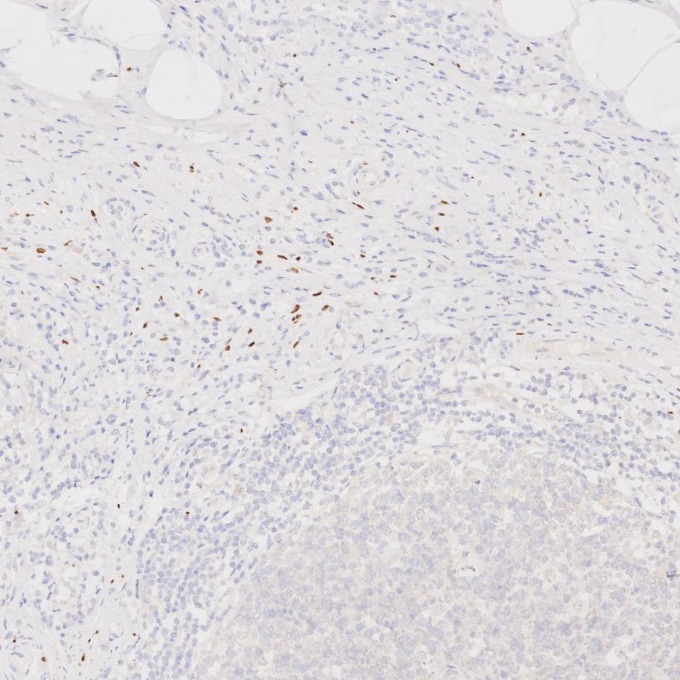 IHC staining of human appendicitis using 66786-1-Ig IHC staining of human appendicitis using 66786-1-Ig