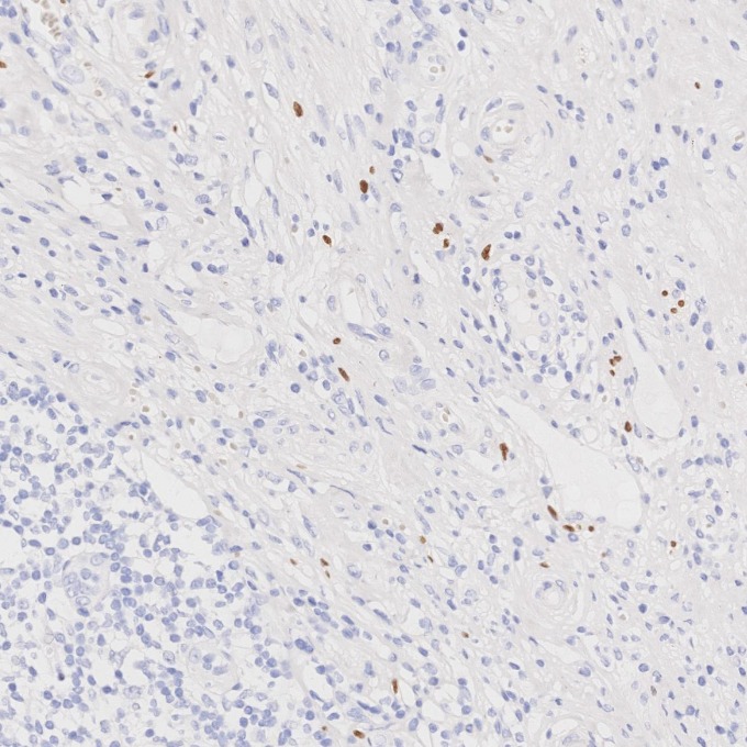 IHC staining of human appendicitis using 66786-1-Ig IHC staining of human appendicitis using 66786-1-Ig