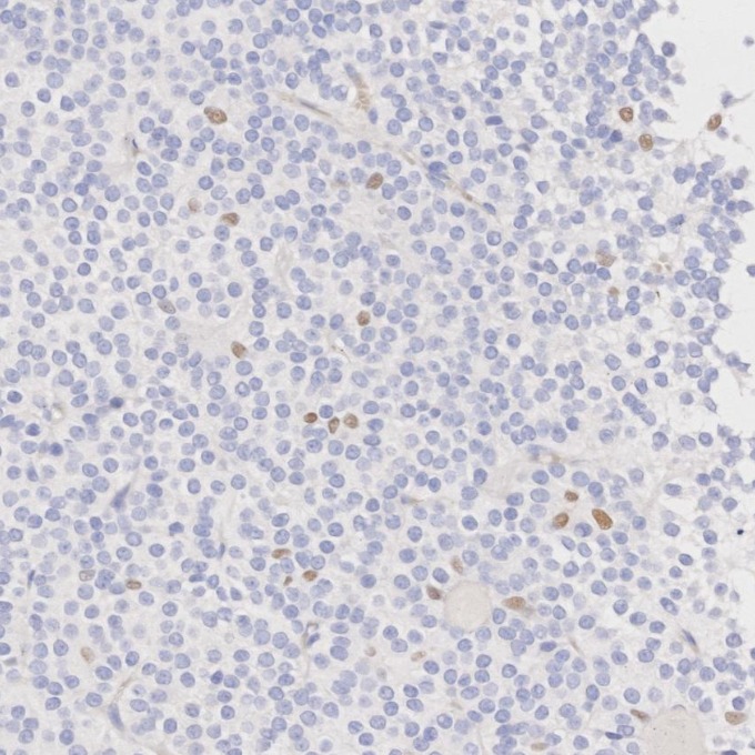 IHC staining of human pituitary adenoma using 66786-1-Ig IHC staining of human pituitary adenoma using 66786-1-Ig