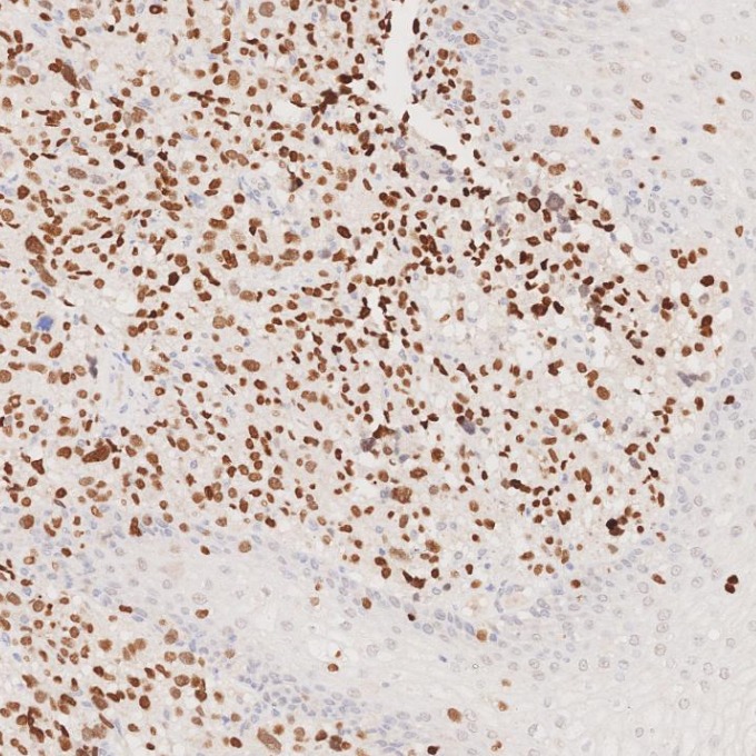 IHC staining of human malignant melanoma using 66786-1-Ig IHC staining of human malignant melanoma using 66786-1-Ig