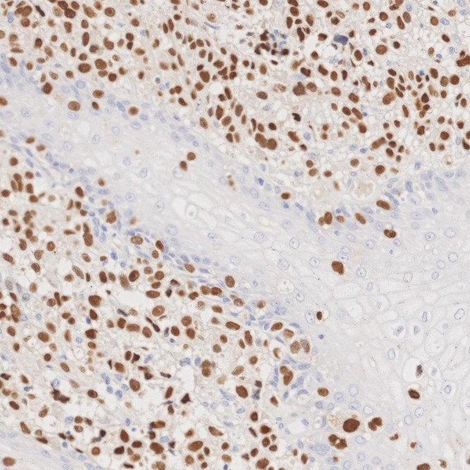 IHC staining of human malignant melanoma using 66786-1-Ig IHC staining of human malignant melanoma using 66786-1-Ig