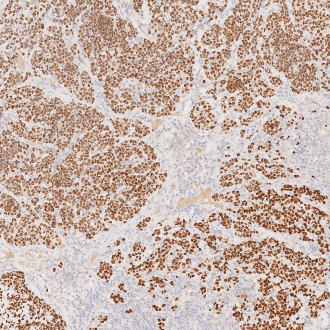 IHC staining of human malignant melanoma using 66786-1-Ig IHC staining of human malignant melanoma using 66786-1-Ig