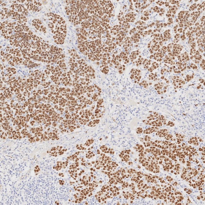 IHC staining of human malignant melanoma using 66786-1-Ig IHC staining of human malignant melanoma using 66786-1-Ig