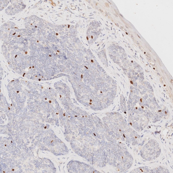 IHC staining of human skin cancer using 66786-1-Ig IHC staining of human skin cancer using 66786-1-Ig