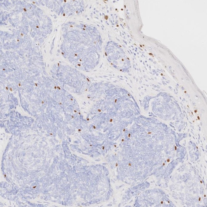 IHC staining of human skin cancer using 66786-1-Ig IHC staining of human skin cancer using 66786-1-Ig