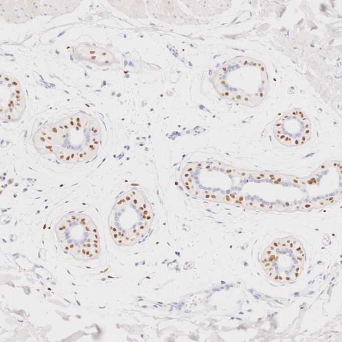 IHC staining of human skin cancer using 66786-1-Ig IHC staining of human skin cancer using 66786-1-Ig