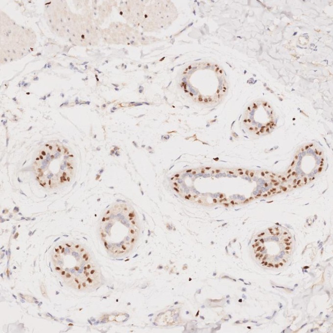 IHC staining of human skin cancer using 66786-1-Ig IHC staining of human skin cancer using 66786-1-Ig