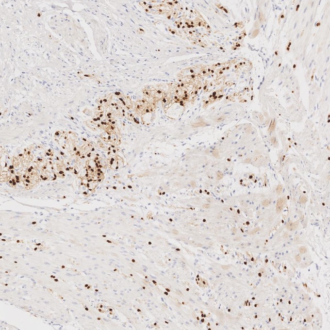 IHC staining of human colorectal cancer using 87051-3-RR (same clone as 87051-3-PBS)