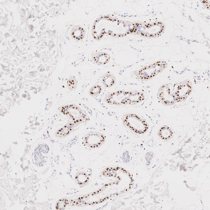 IHC staining of human skin cancer using 87051-3-RR (same clone as 87051-3-PBS)