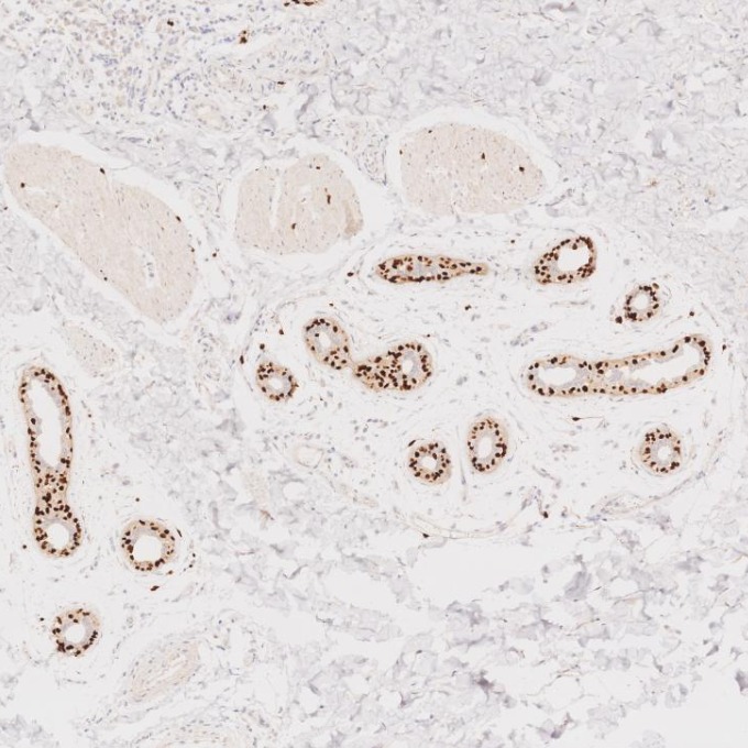 IHC staining of human skin cancer using 87051-3-RR (same clone as 87051-3-PBS)