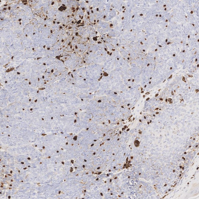 IHC staining of human skin cancer using 87051-3-RR (same clone as 87051-3-PBS)