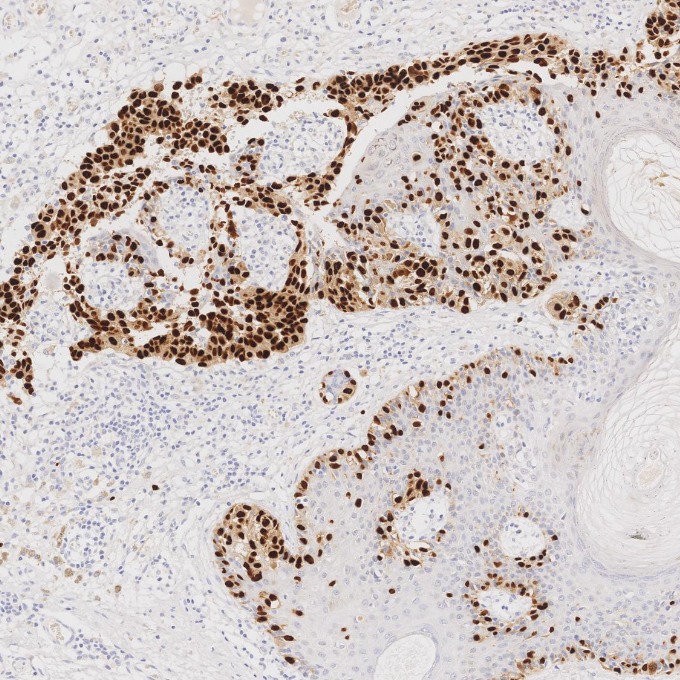 IHC staining of human malignant melanoma using 87051-3-RR (same clone as 87051-3-PBS)