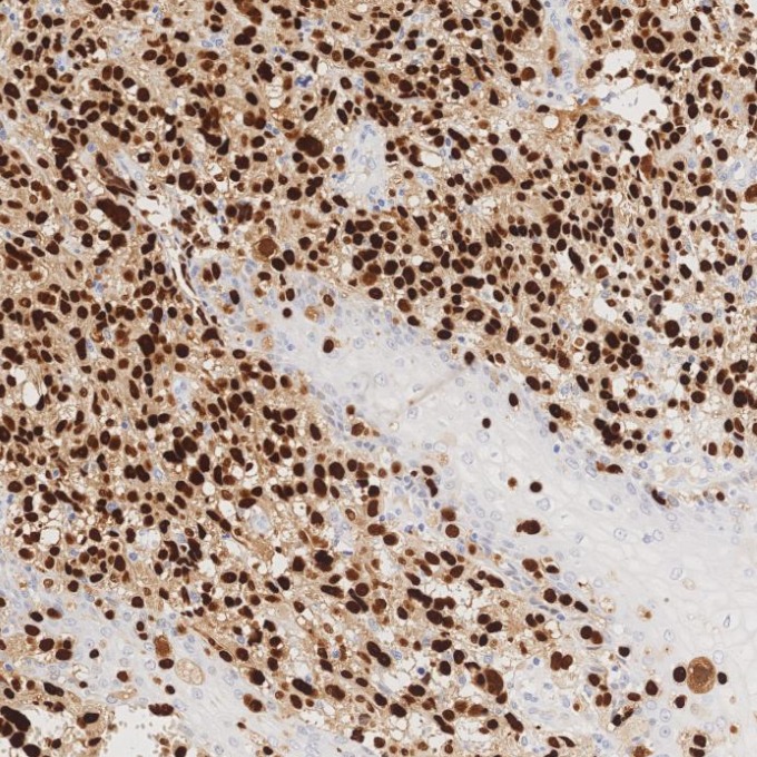 IHC staining of human malignant melanoma using 87051-3-RR (same clone as 87051-3-PBS)
